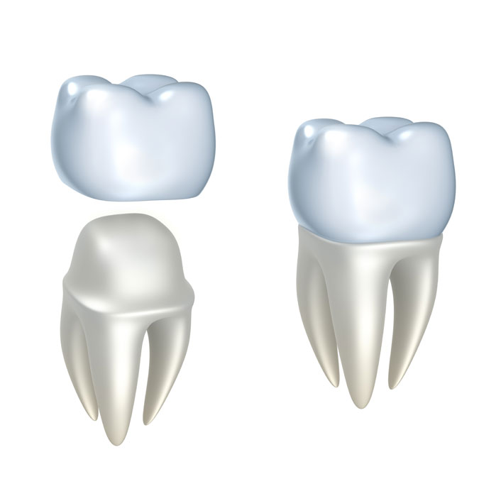 Crowns - Dental Services