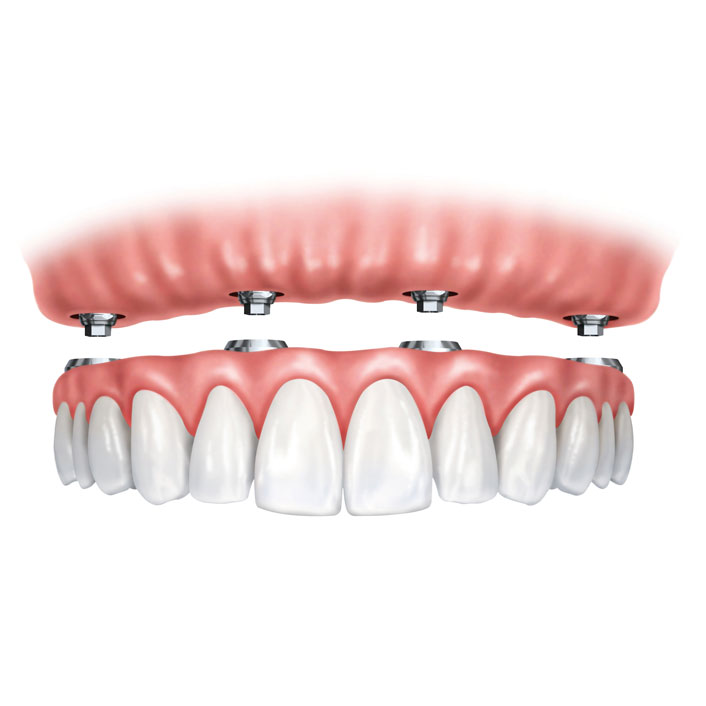 Implant Supported Dentures - Dental Services