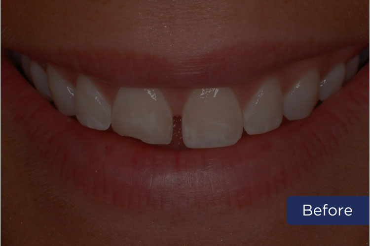nicholson dentistry - Patient 4 - Before