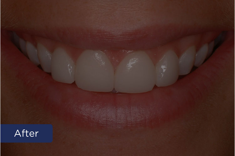 nicholson dentistry - Patient 4 - After